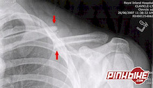 Mike Kinrade serves himself a tall glass and gets a broken collar bone in the process
